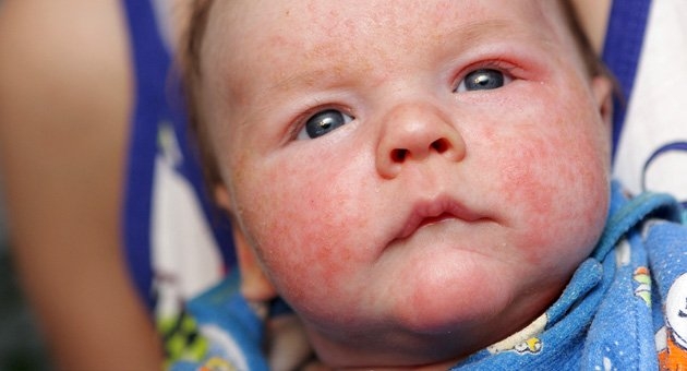 Bebek ve Çocuklarda Görülen Cilt Hastalıkları 3