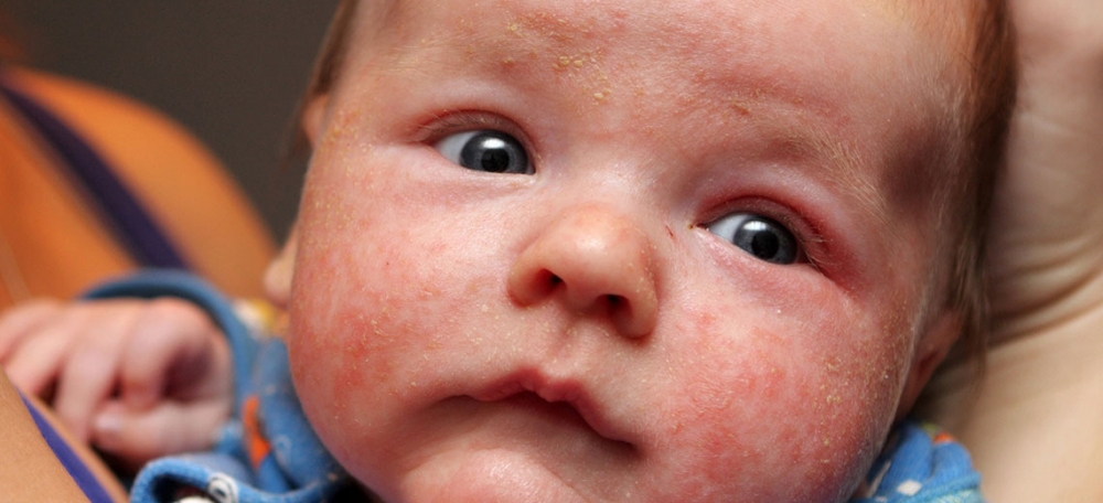 Bebek ve Çocuklarda Görülen Cilt Hastalıkları 5