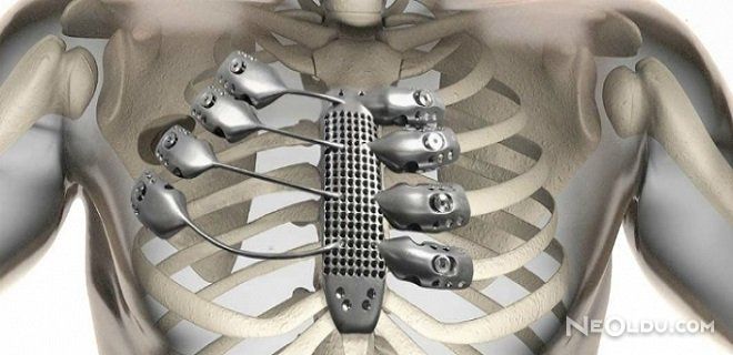 3D Yazıcı İle Göğüs Kemiği Üretildi