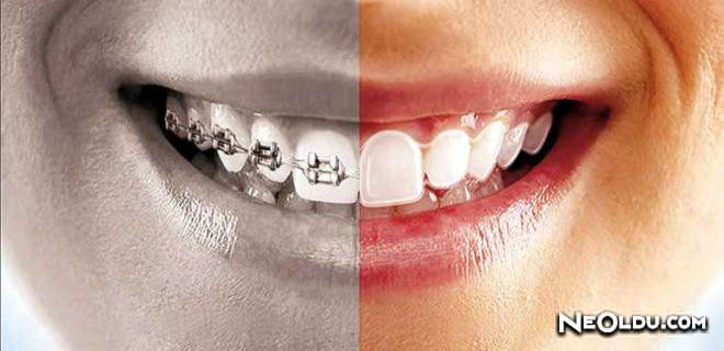 Ortodonti Tedavisi Ne Kadar Sürer?