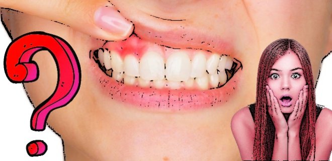 Diş Eti Hastalığı Nedenleri ve Tedavisi