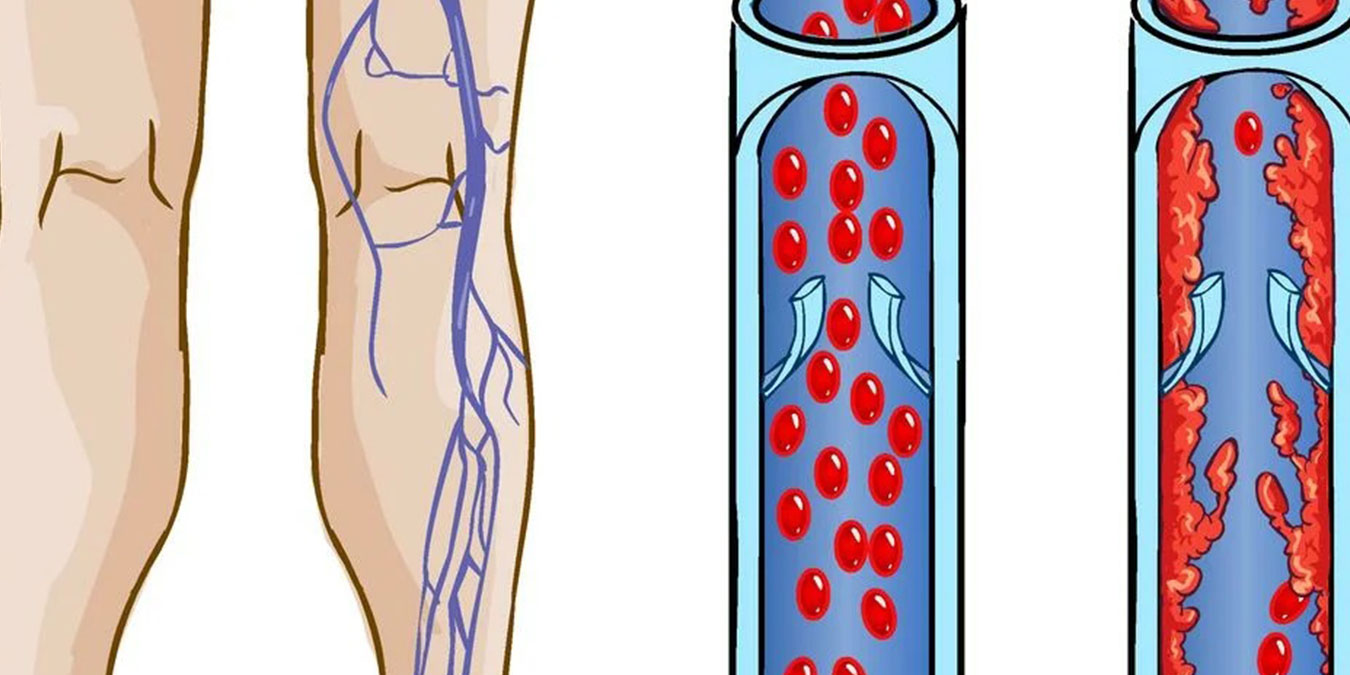 Тромбоз артерий лечение. Флеботромбоз глубоких вен нижних конечностей. Флебит тромбофлебит флеботромбоз. Тромбэктомия глубоких вен. Тромбофлебит поверхностных вен голени.