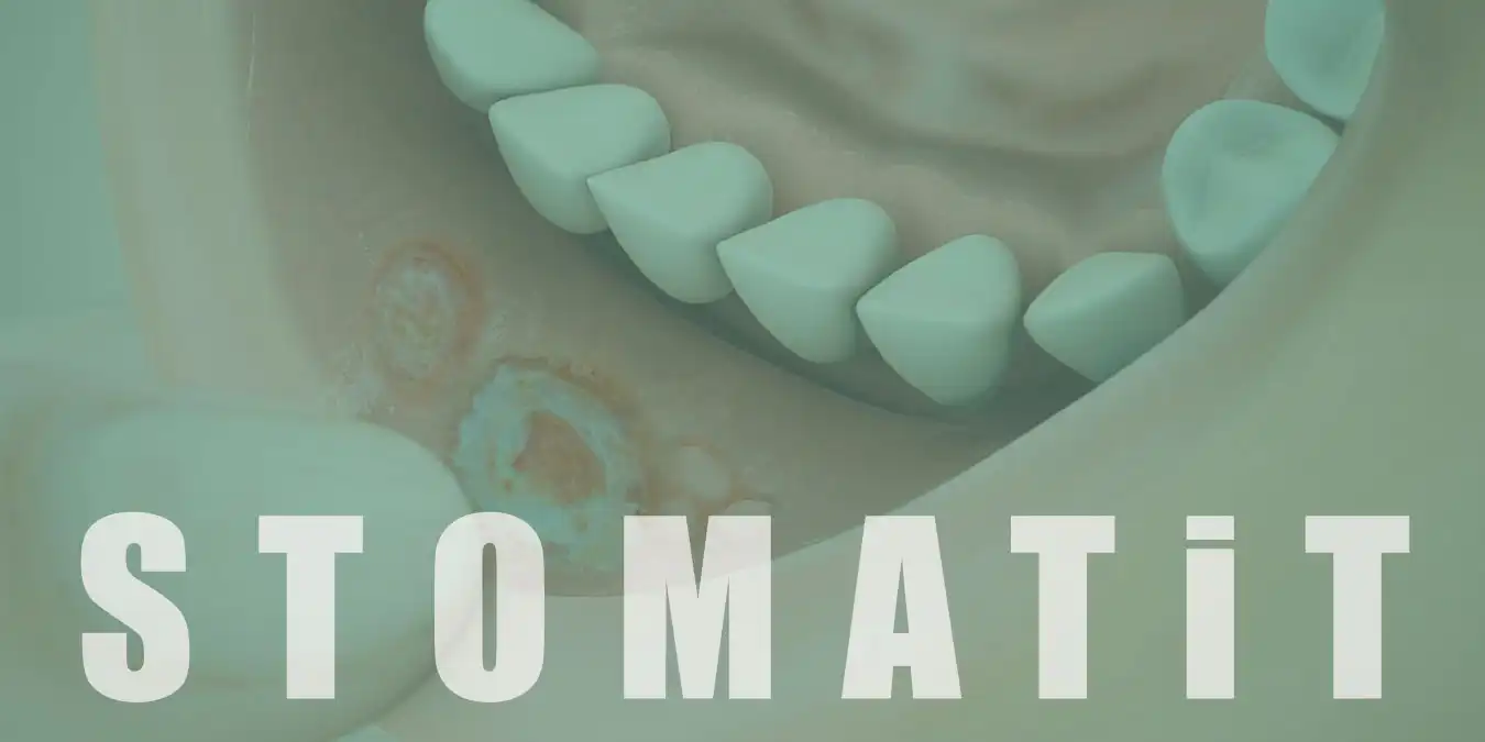 Stomatit (Ağızda Yara) Nedir, Belirtileri Nelerdir? Tedavisi