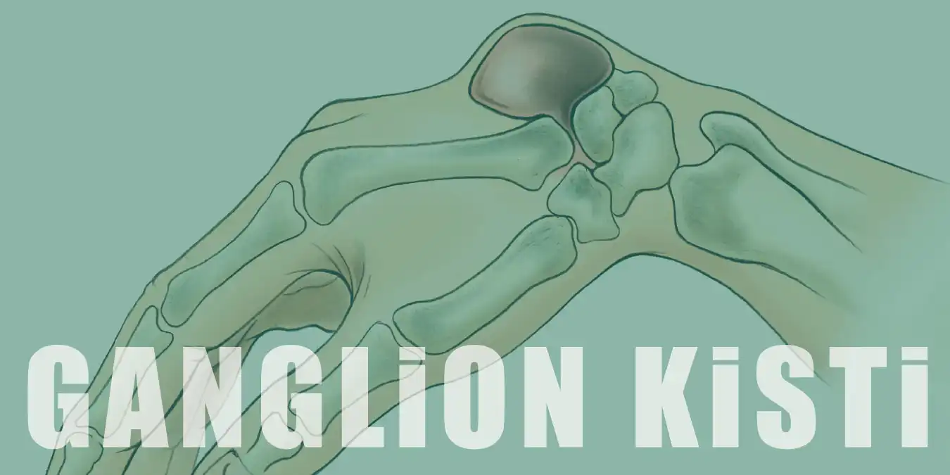 Ganglion Kisti Nedir? Neden Olur ve Nasıl Tedavi Edilir?