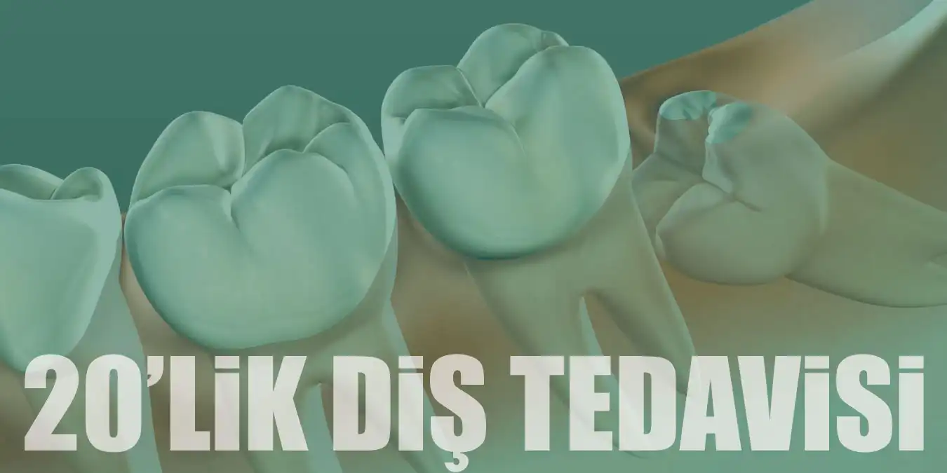 20'lik Diş Nedir ve Nasıl Tedavi Edilir?