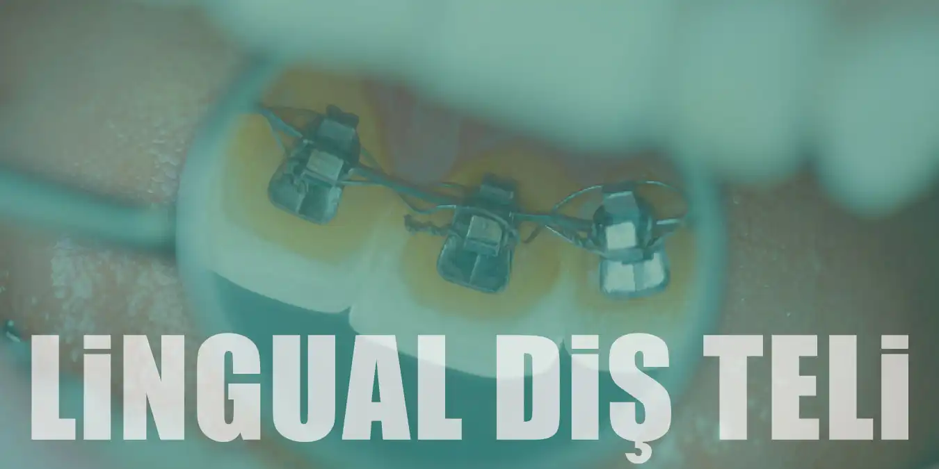 Lingual Diş Teli (Görünmez Diş Teli) Nedir? Özellikleri