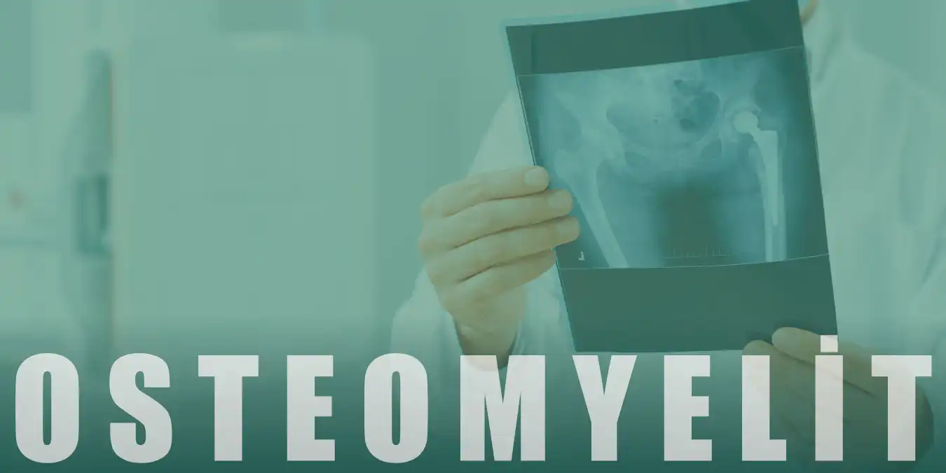 Osteomyelit (Kemik İltihabı) Nedir, Tedavisi Nelerdir?