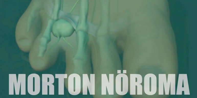 Morton Nöroma Nedir? Nedenleri, Belirtileri ve Tedavisi