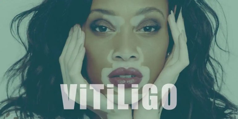 Vitiligo Nedir? Vitiligo Başlangıcı, Belirtileri ve Tedavisi