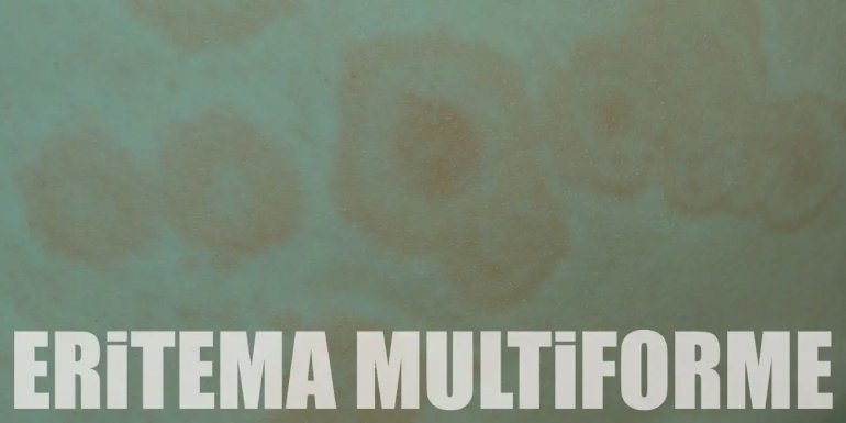 Eritema Multiforme Nedir? Nedenleri, Belirtileri ve Tedavisi