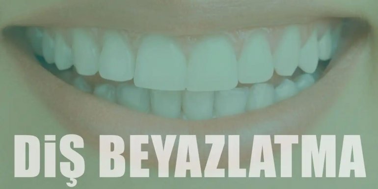Diş Beyazlatma (Bleaching) Nedir, Nasıl Yapılır?