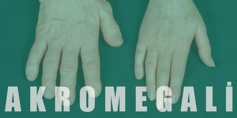 Akromegali Nedir, Belirtileri ve Tedavisi Nelerdir?